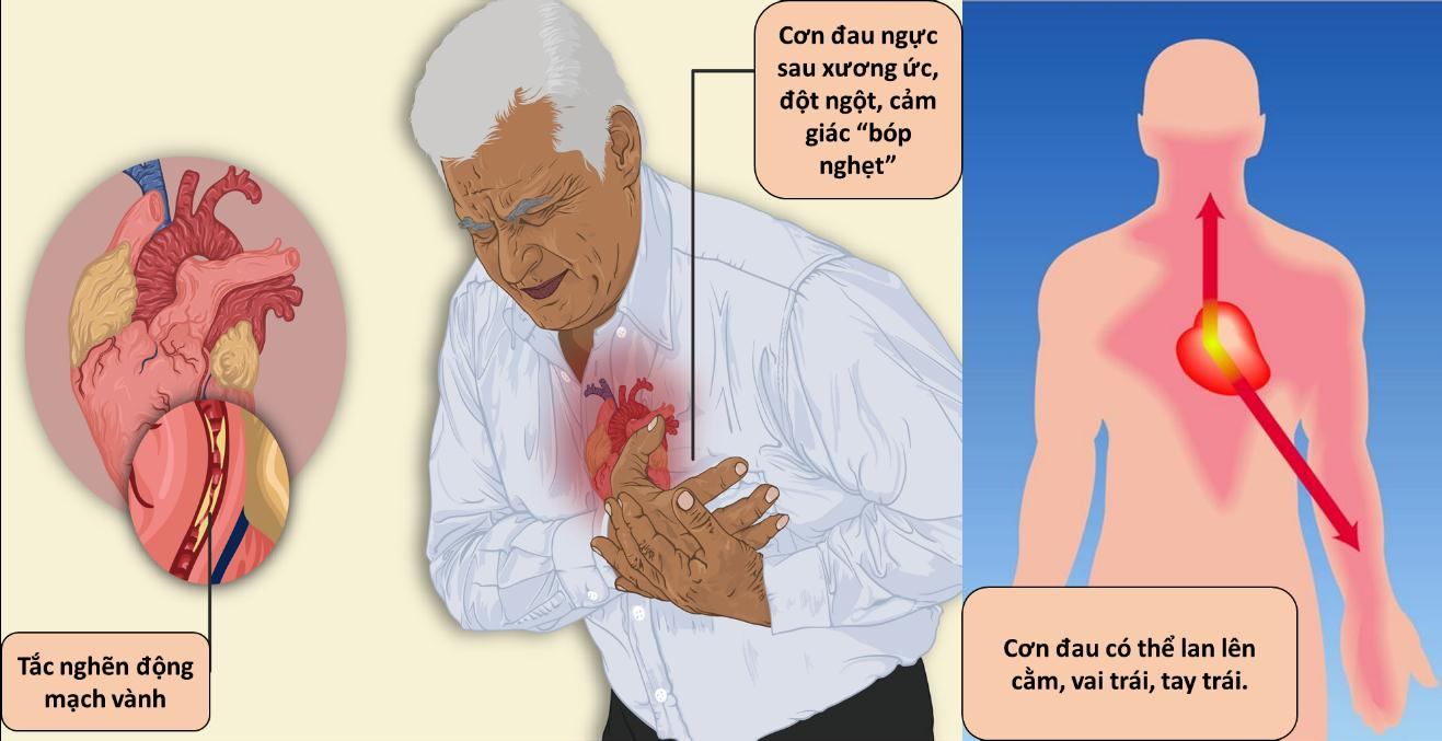 Cảnh báo nhồi máu cơ tim ở người cao tuổi